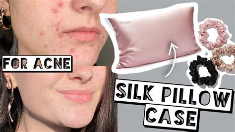 Does sleeping on silk help acne?
