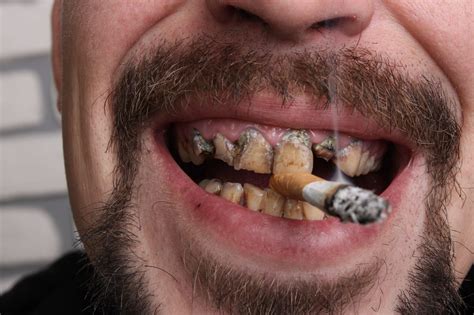 Does smoking cause gray teeth?