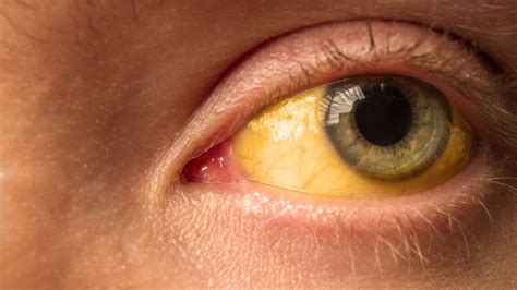 Does smoking make eyes yellow?