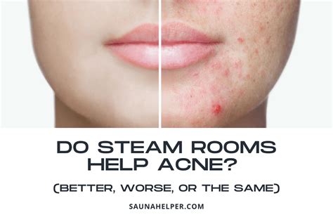 Does steam help acne scars?
