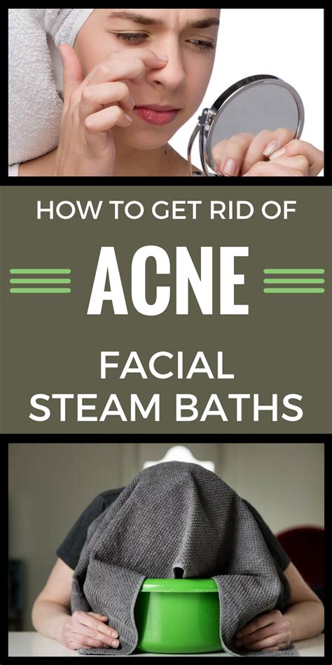 Does steaming get rid of acne?