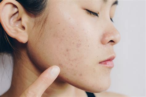 Does steaming reduce acne scars?