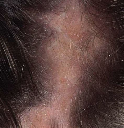 Does stress cause scalp fungus?