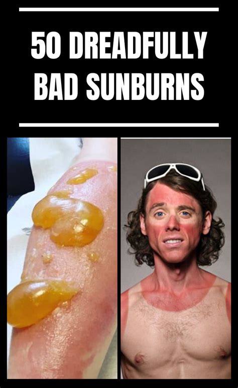 Does sunburn look worse the next day?