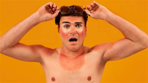 Does sunburn turn into tan?