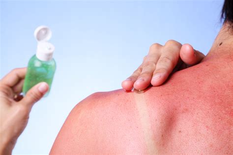 Does sunscreen help after a burn?