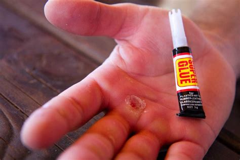 Does super glue burn on wounds?
