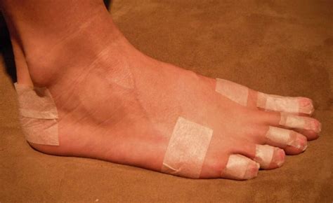 Does taping your feet prevent blisters?