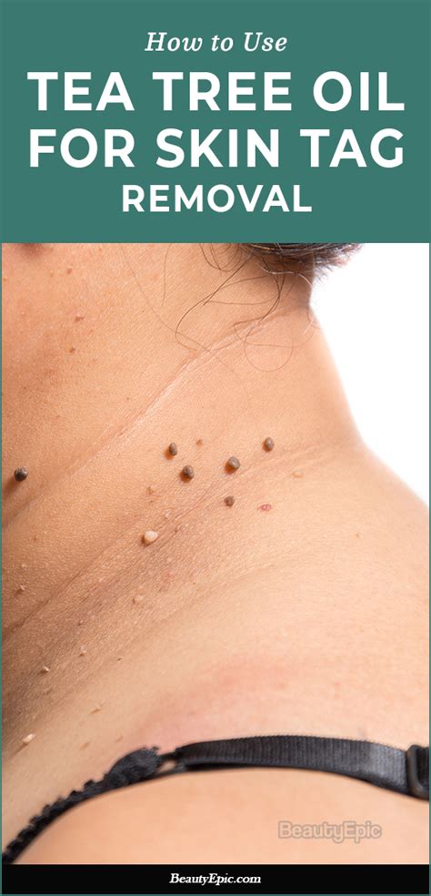 Does tea tree oil remove skin tags?