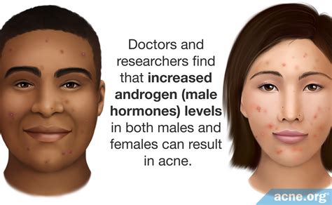 Does testosterone cause acne?