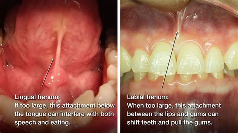 Does the frenulum fix itself?