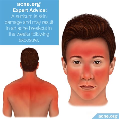 Does the sun help acne?