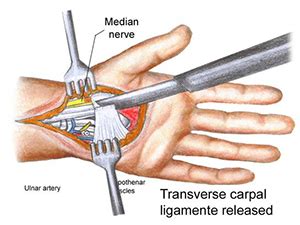 Does the transverse carpal ligament grow back after carpal tunnel surgery?