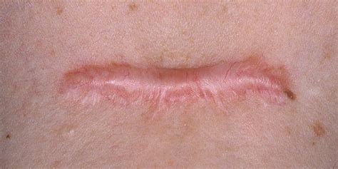Does thin skin scar?