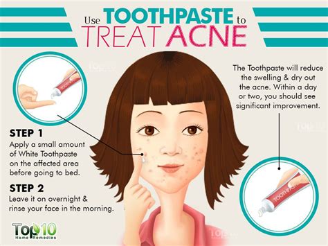 Does toothpaste get rid of back acne?