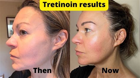 Does tretinoin ruin Botox?