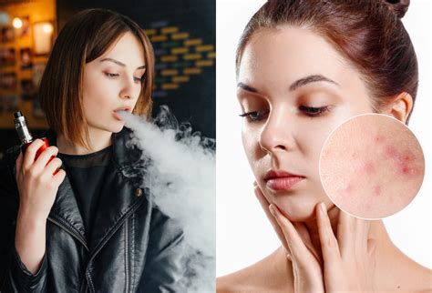 Does vaping cause acne?