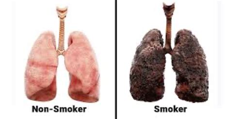 Does vaping cause holes in lungs?