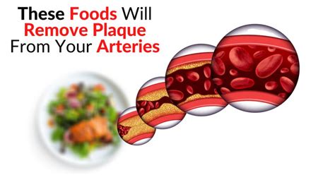 Does vitamin C remove plaque from arteries?