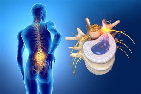 Does vitamin D help with herniated disc?