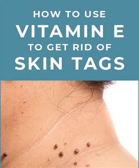 Does vitamin E oil remove skin tags?