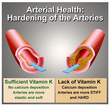 Does vitamin K2 clean arteries?