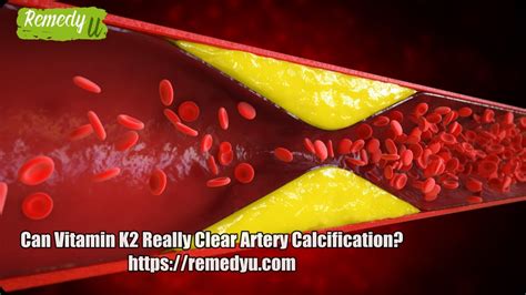 Does vitamin K2 really clean arteries?