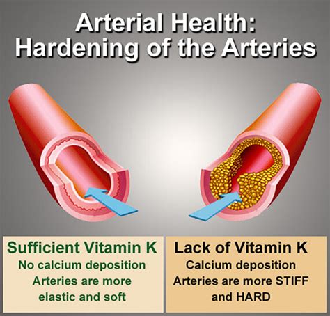 Does vitamin k2 clean arteries?