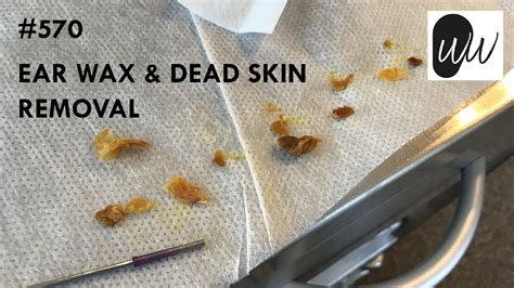Does wax remove dead skin?