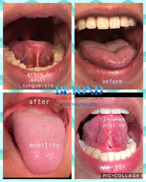 Does your face change after tongue-tie release?