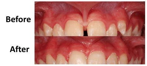 Does your smile change after frenectomy?