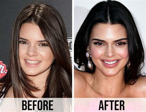 Has Kendall Jenner changed her face?