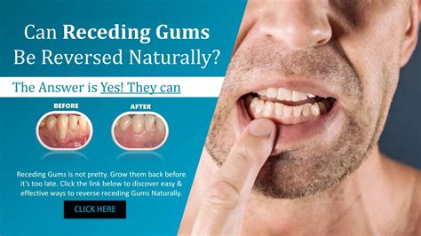 Has anyone reversed receding gums?