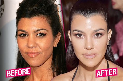 Have the Kardashians had Botox?