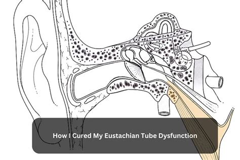 How I cured my Eustachian tube dysfunction naturally?
