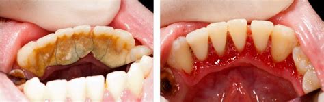 How I cured my periodontal disease?