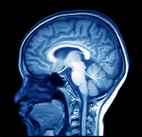 How accurate are MRI scans of the brain?