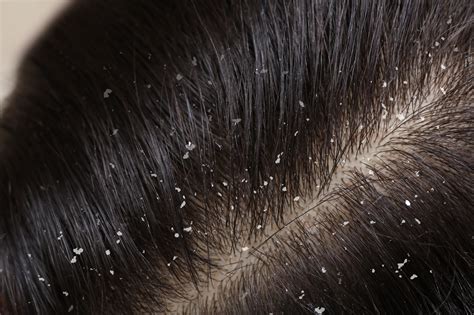 How bad can dandruff get?