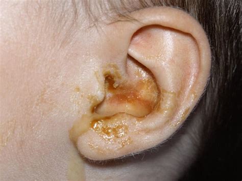 How bad is an ear infection with pus?