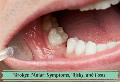 How bad is it to lose a molar?