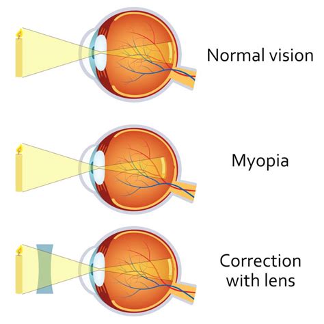 How bad is myopia?