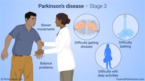 How bad is stage 3 Parkinson's?