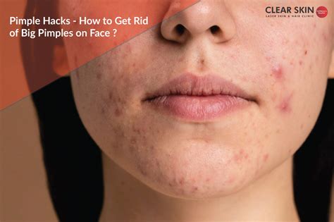 How big can pimples get?