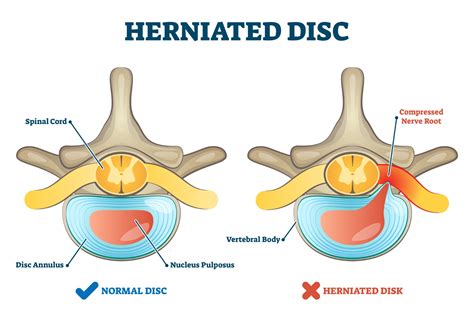 How big is a bad herniated disc?