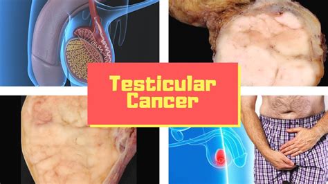 How big is a testicular cancer lump?