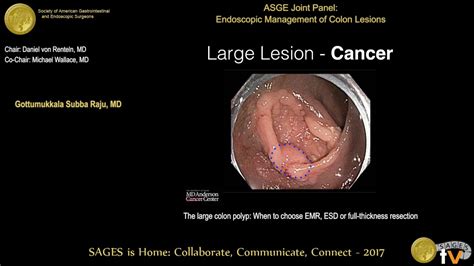 How big is a very large polyp?