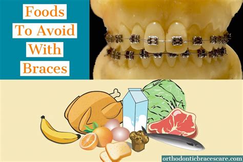 How can I avoid braces?