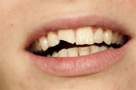 How can I cover my broken teeth?