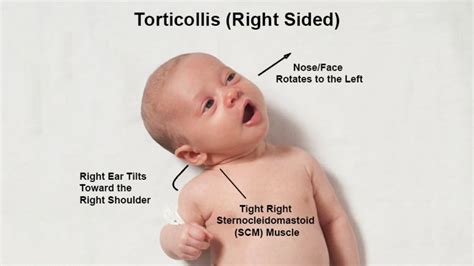 How can I fix torticollis?