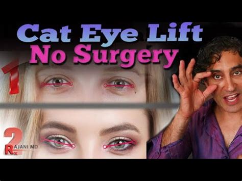 How can I get my cat's eye lift without surgery?